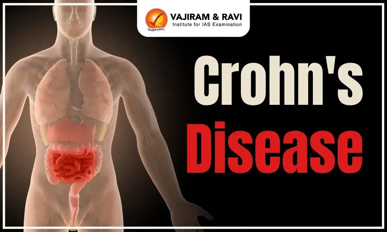 Crohn’s Disease