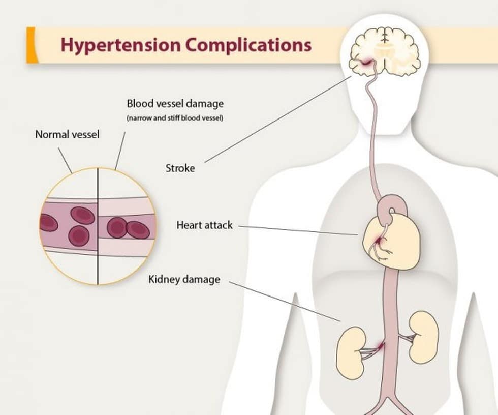 Hypertension