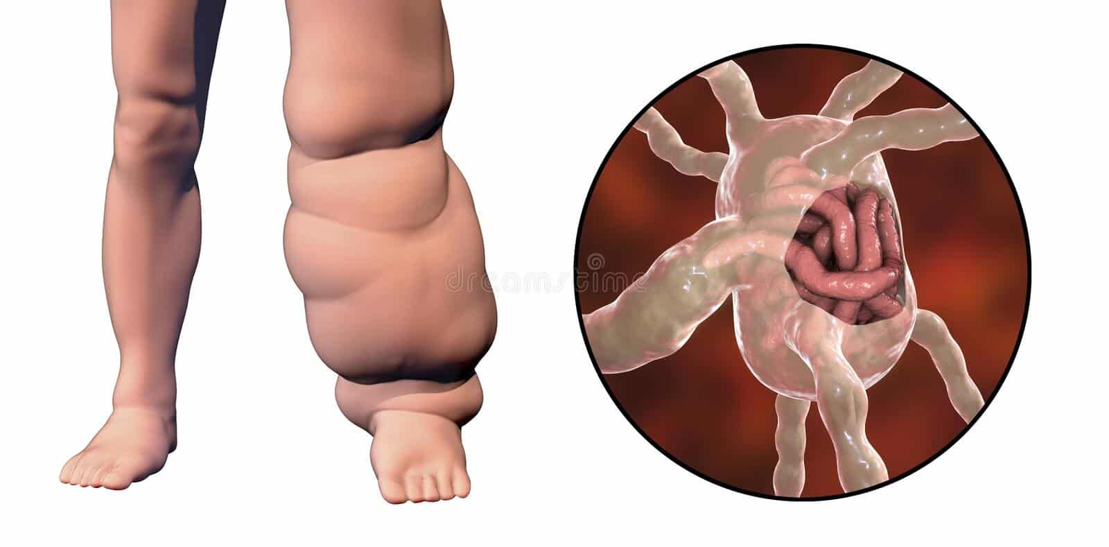 Lymphatic Filariasis