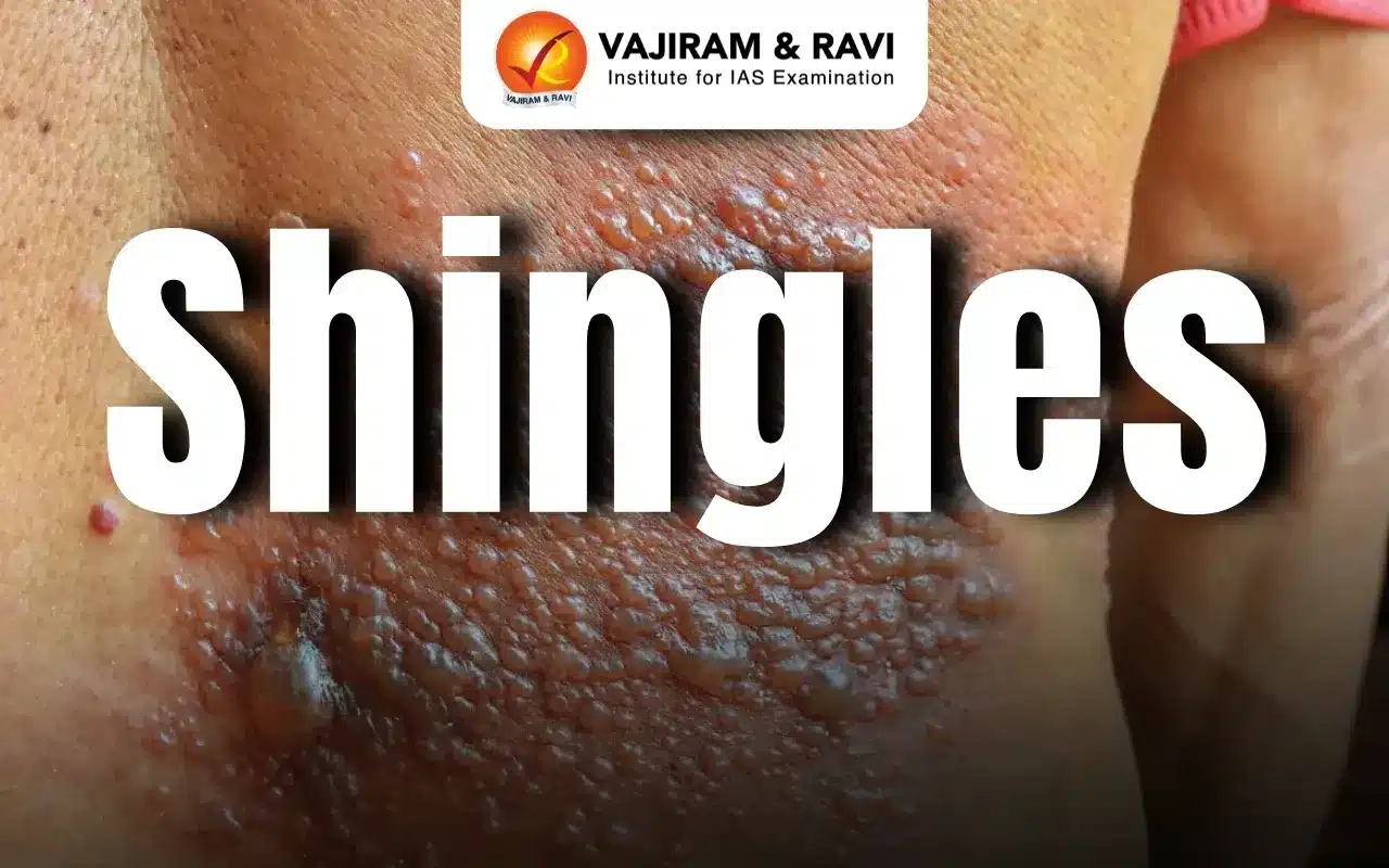Shingles Disease