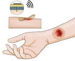 Smart Bandage