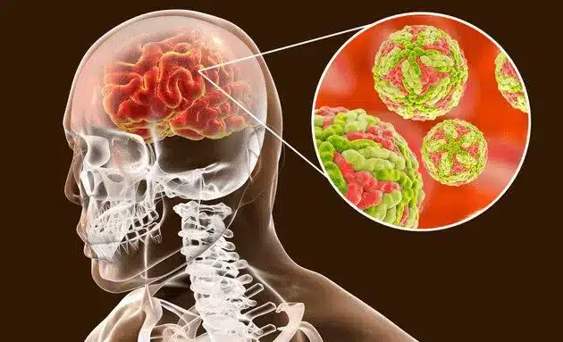 Acute Encephalitis Syndrome (AES)