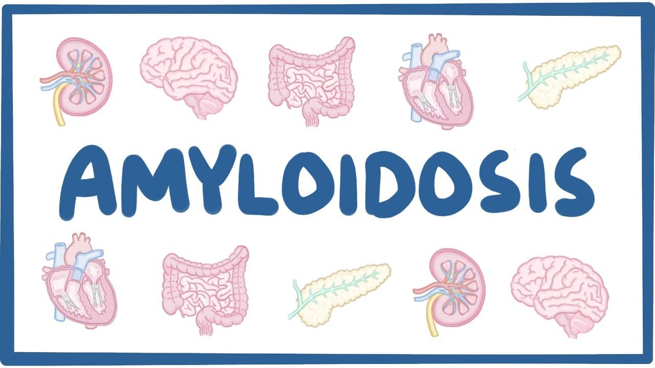 Amyloidosis