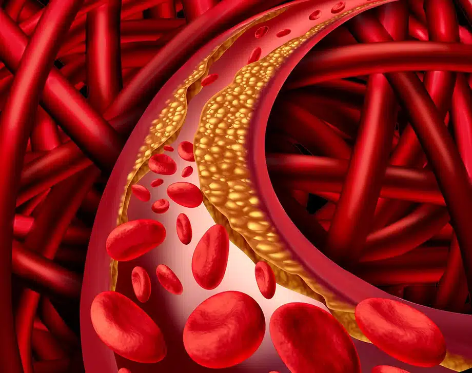 What is Bad Cholesterol?