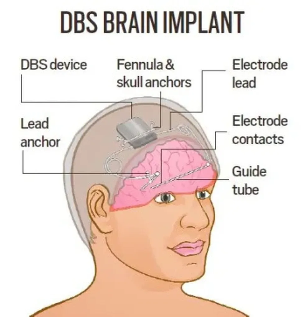 Deep Brain Stimulation Device