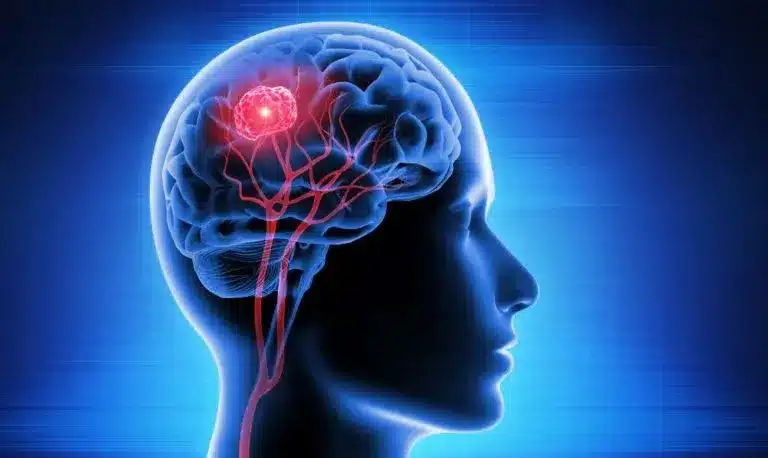What is Glioblastoma?