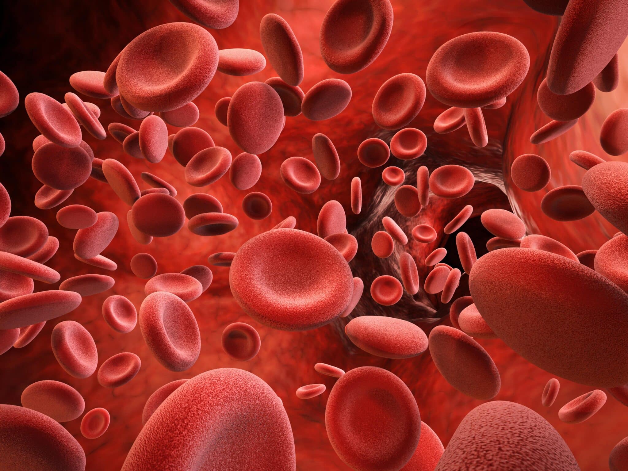 Hemochromatosis