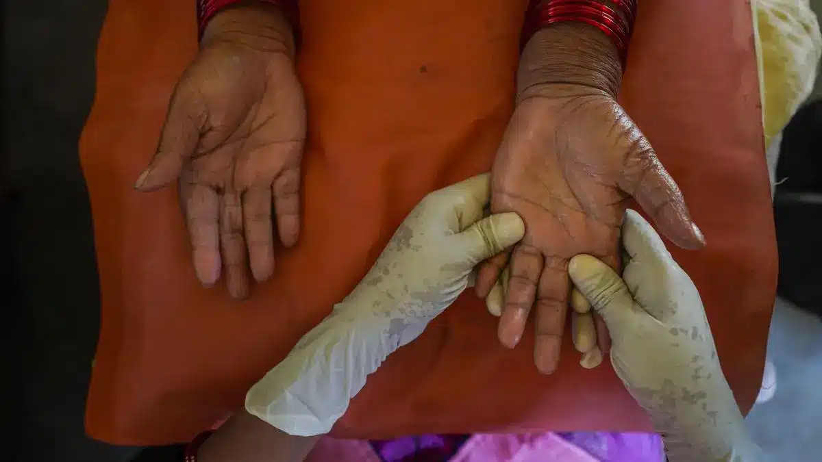 Health Ministry’s new Treatment Regimen for Leprosy