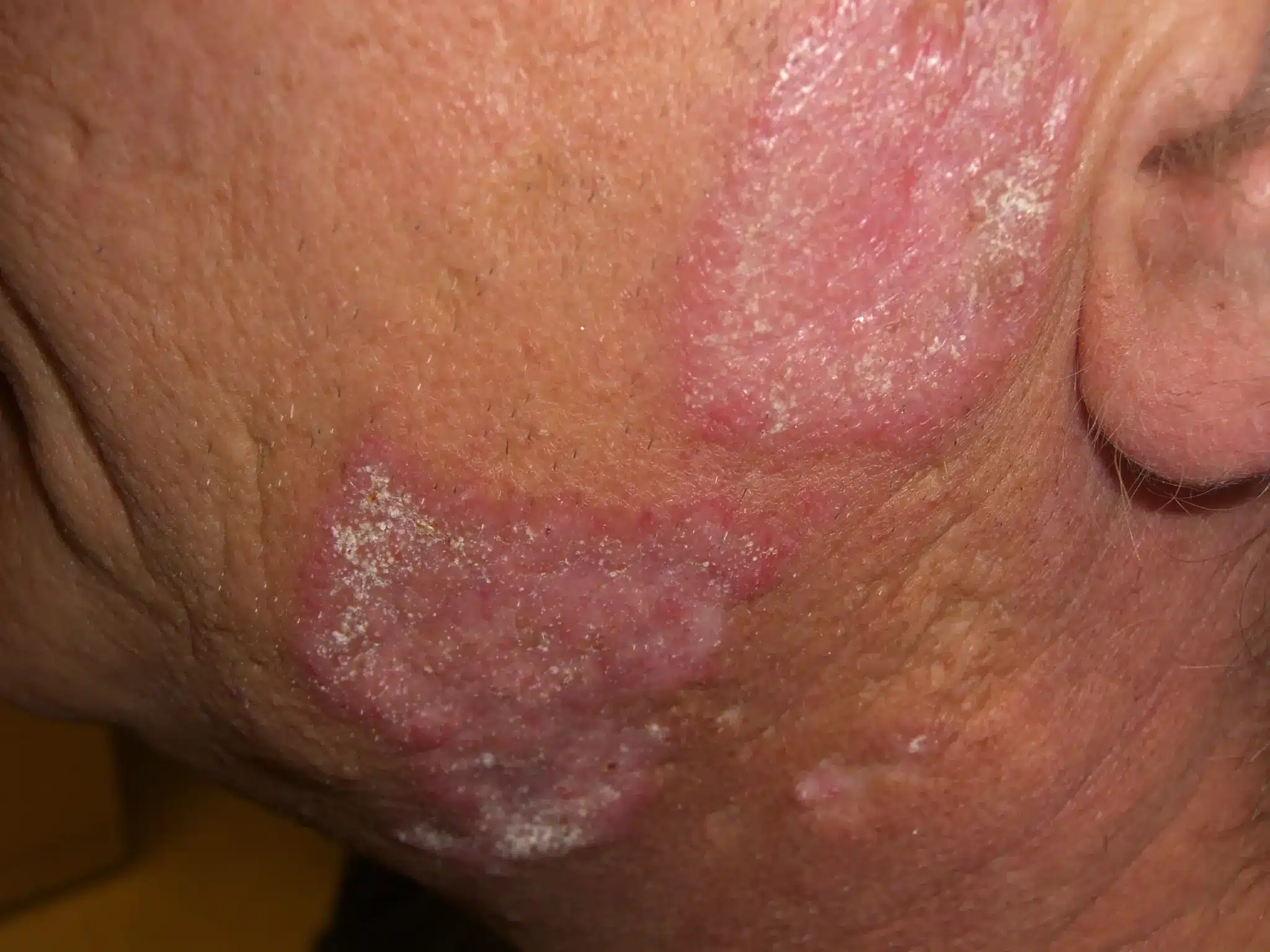 What is Lupus?