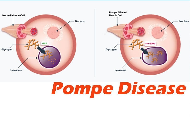 What is Pompe disease?