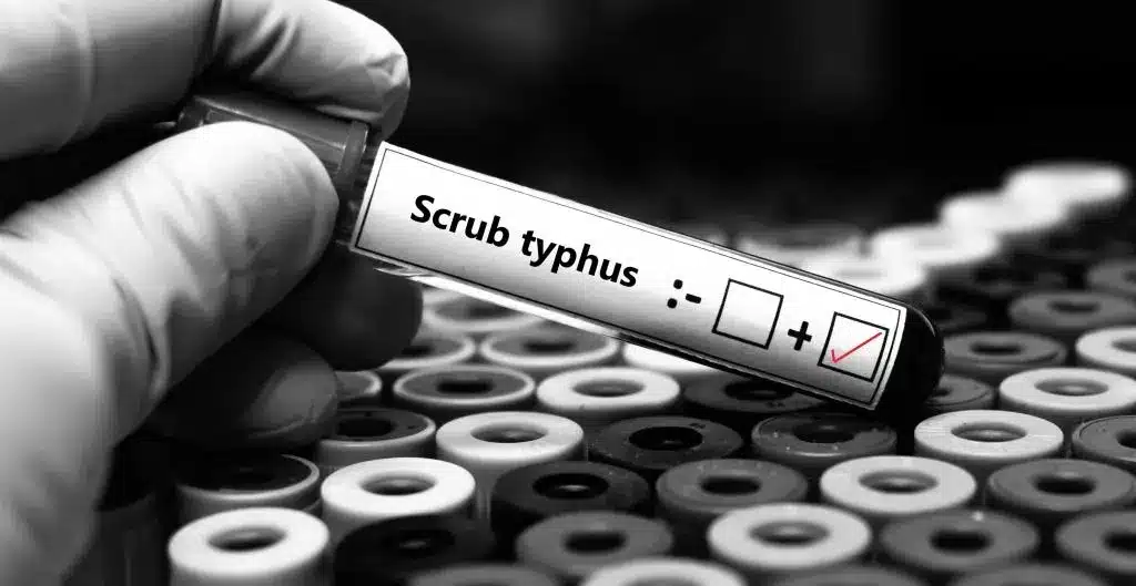 Scrub Typhus