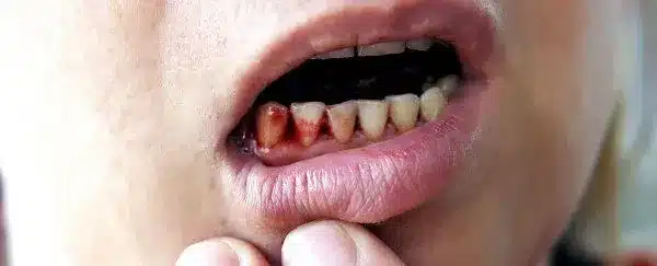 What is Scurvy?