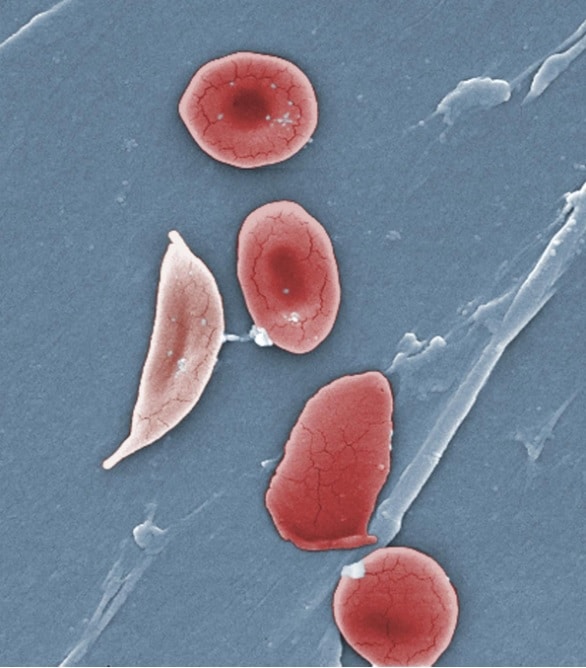 Sickle Cell Anaemia