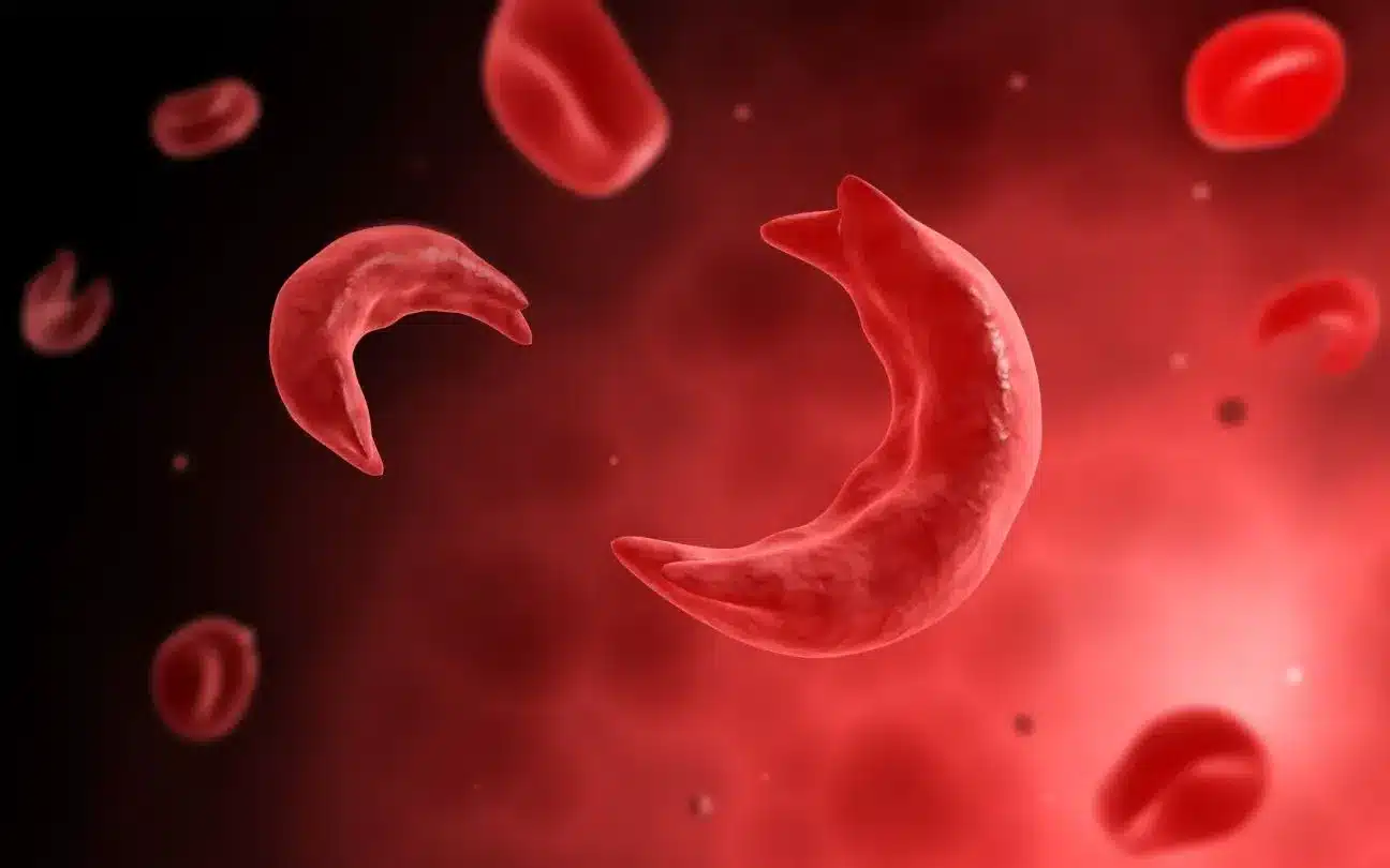 What is Sickle Cell Disease (SCD)?