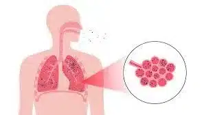 What is Silicosis?