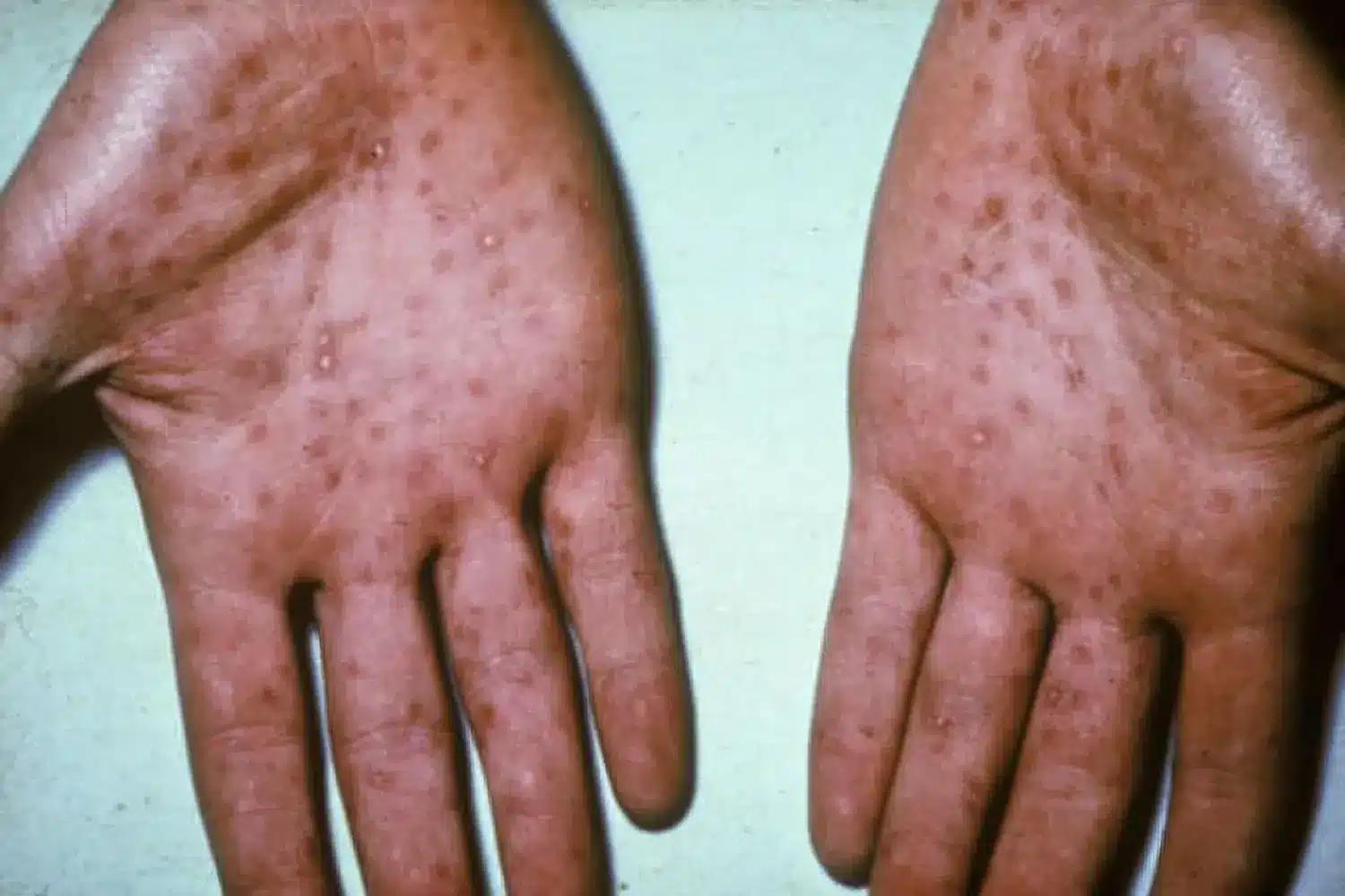 What is Syphilis?