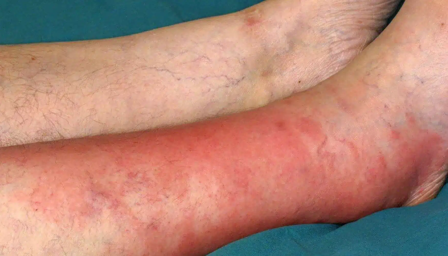 What is Cellulitis Disease?