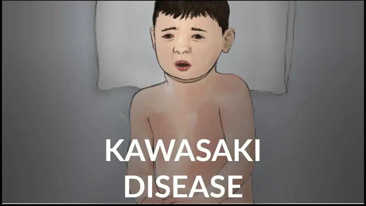 What is Kawasaki Disease?