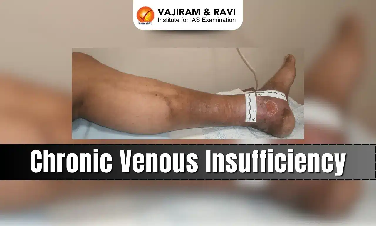 Chronic Venous Insufficiency