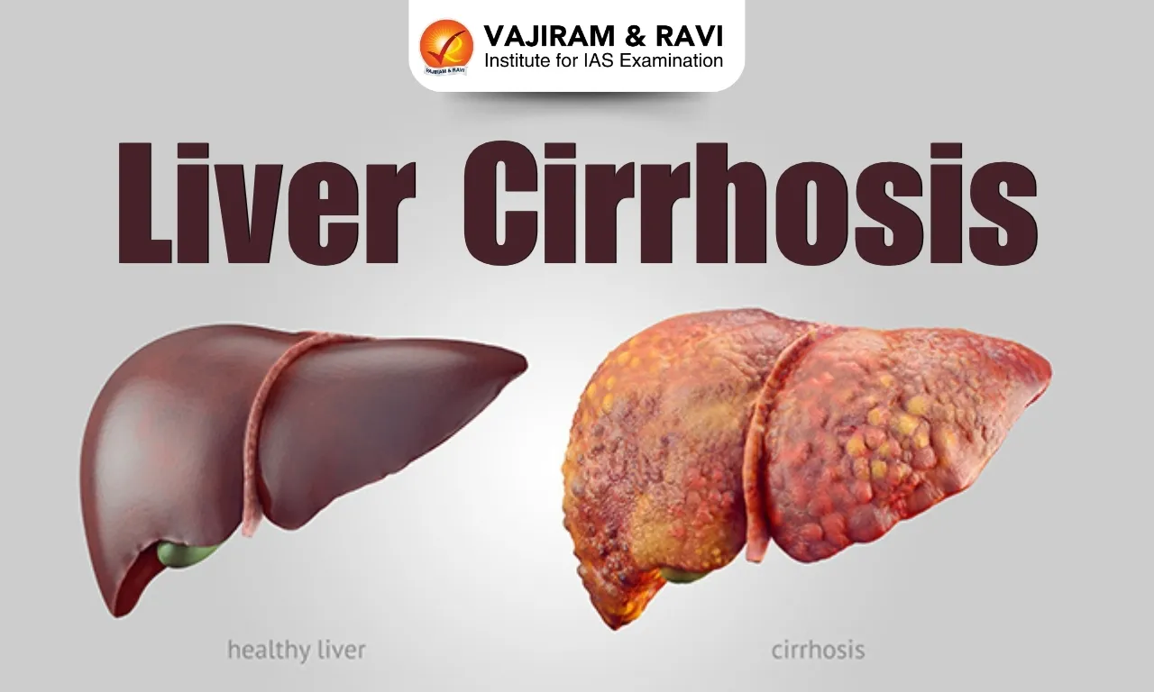 Liver Cirrhosis