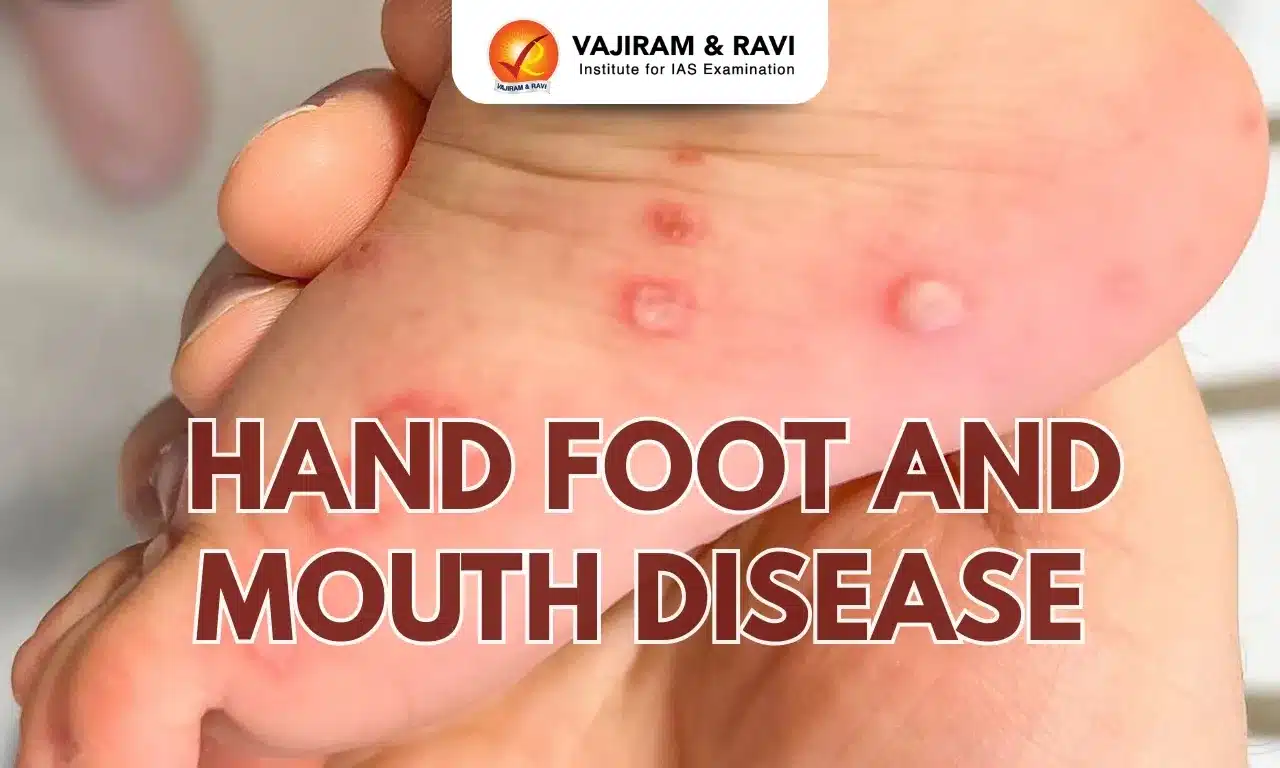 Hand, Foot, and Mouth Disease