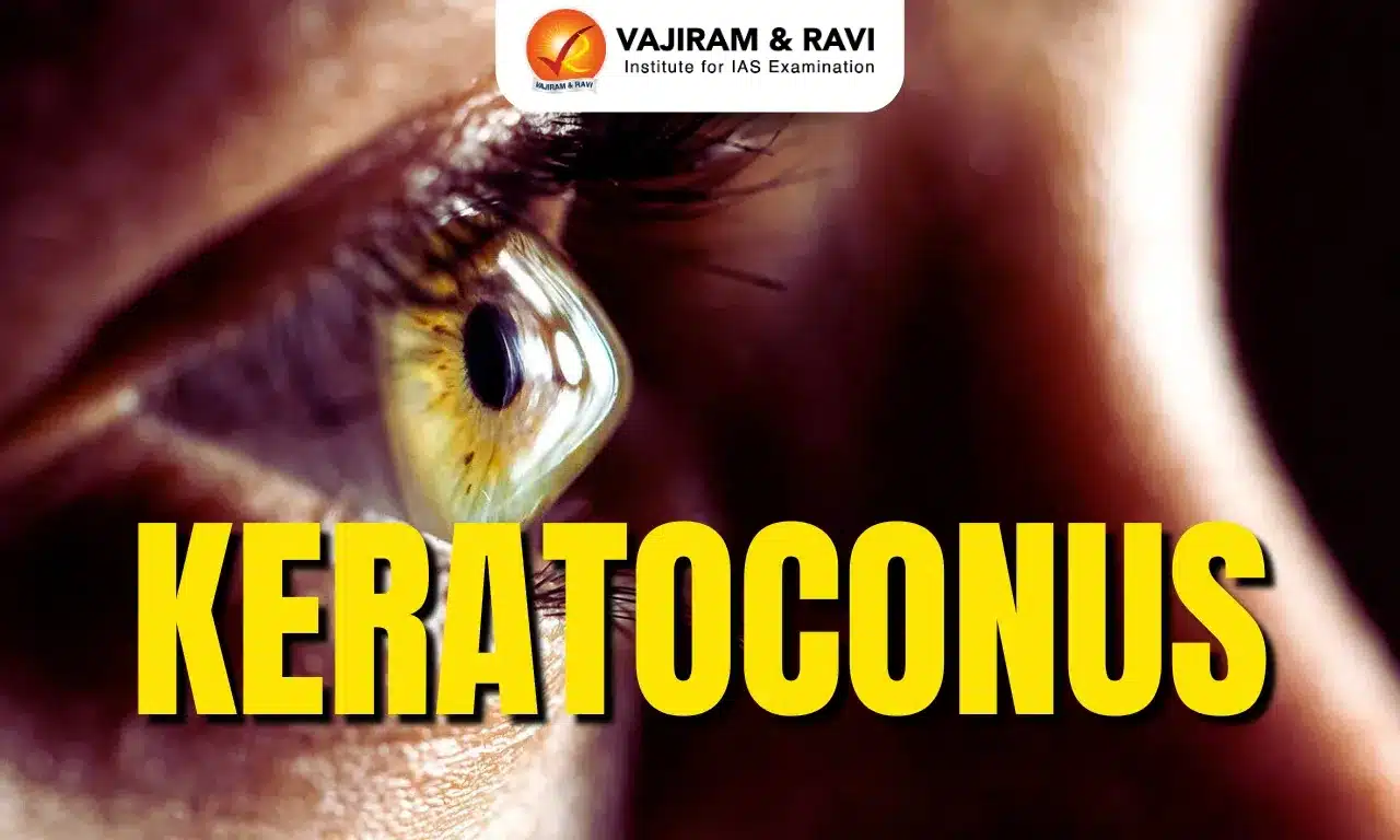 Keratoconus
