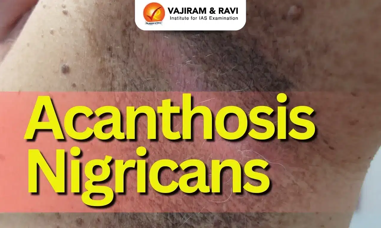 Acanthosis Nigricans